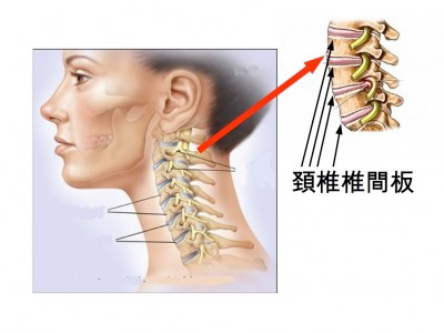 頚椎ヘルニアと噛み合わせ3