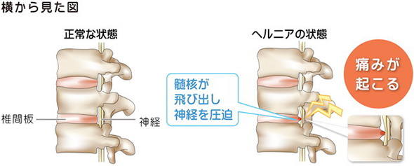 頚椎ヘルニアと噛み合わせ4