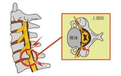 頚椎ヘルニアと噛み合わせ5