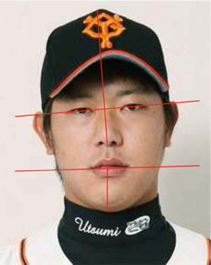 アスリートに見る顔の歪みと首の回旋可動域-噛み合わせの調整の有効性-1