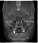 アスリートに見る顔の歪みと首の回旋可動域-噛み合わせの調整の有効性-29